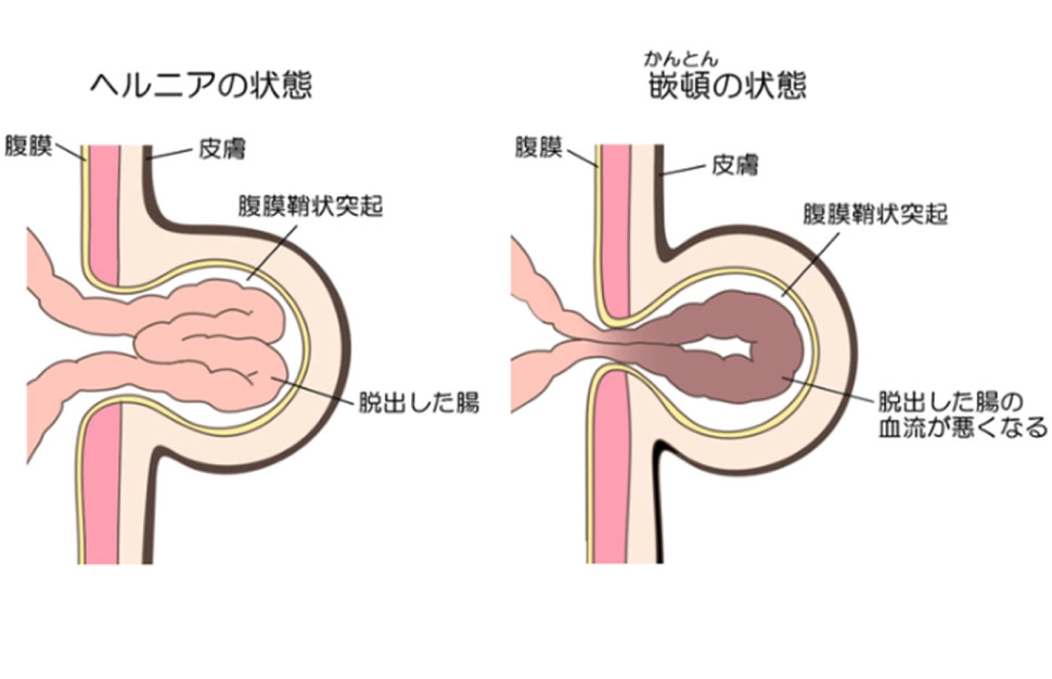 ヘルニアの症状